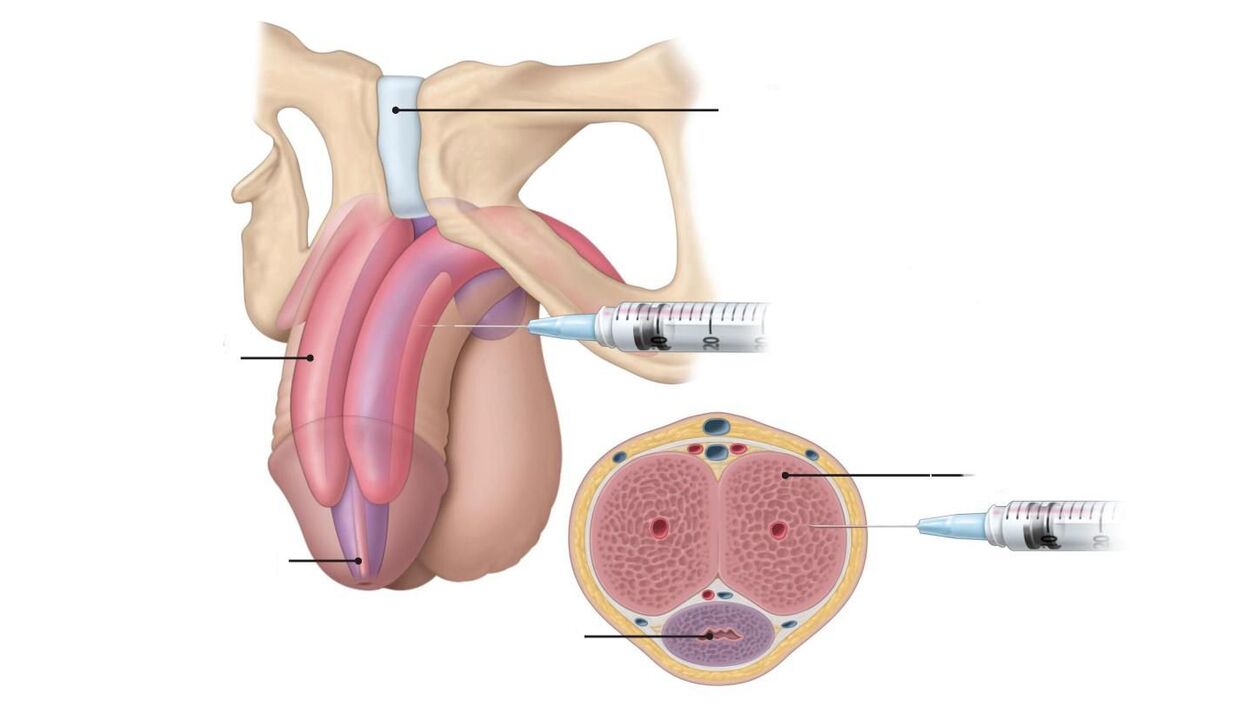 injections for penis enlargement