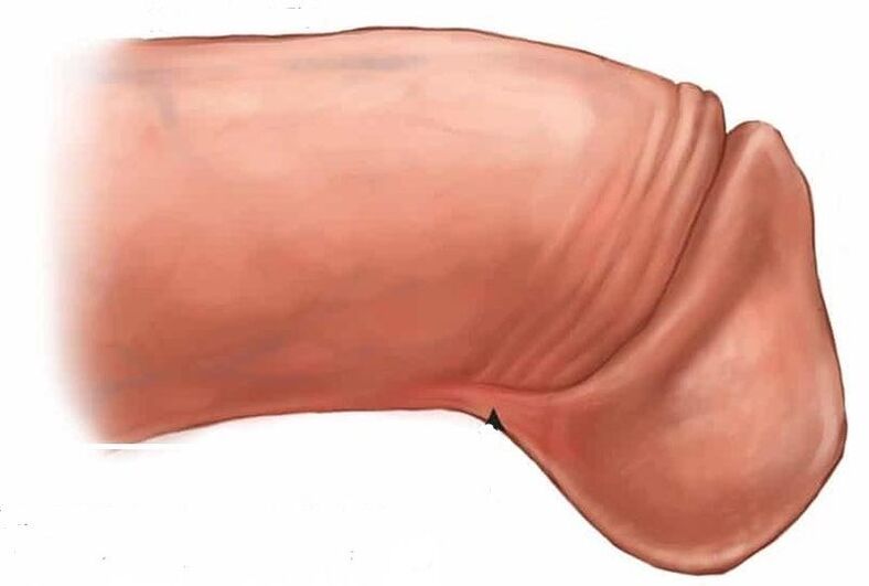 how to enlarge the head of the penis