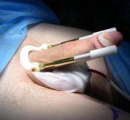 How to perform penis enlargement surgery